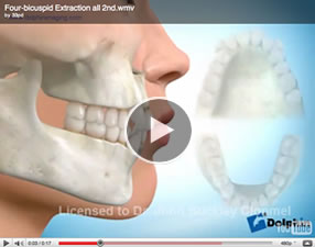 What are the main steps of a front tooth extraction procedure?