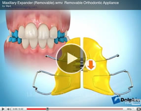 Removablebracesv2 Removable Braces