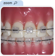 fixedbraces1