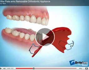 removablebraces3v Removable Braces