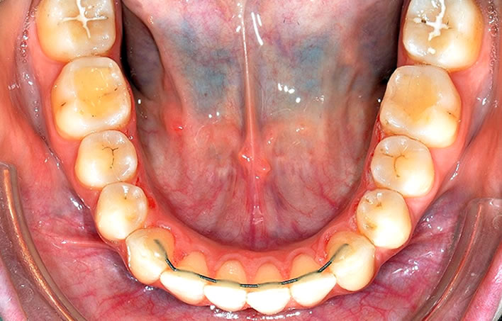 retainer61 What are bonded  (fixed) orthodontic retainers?