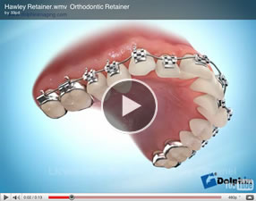 How Much Do Retainers Cost To Make - change comin