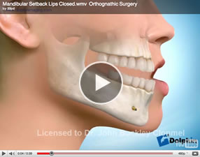 o14 Orthognathic Surgery