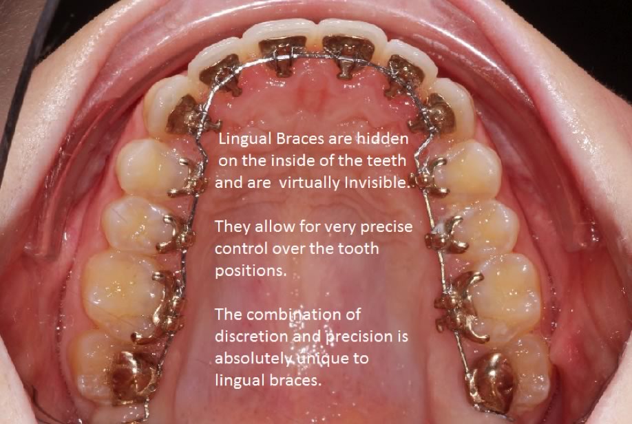 LO-Benefits-Image-1-1 The Benefits of Lingual Orthodontics