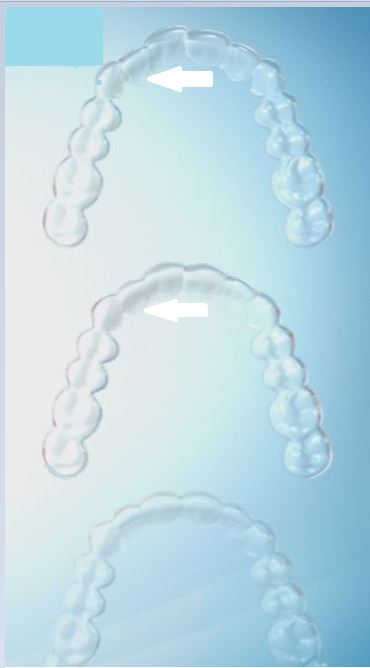 aligner-1 Why Do I Need  Attachments Bonded to My Teeth for Invisalign?