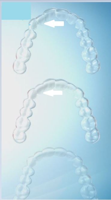 aligner-1 What is Invisalign and How Does it Make Teeth Move ? Part A.