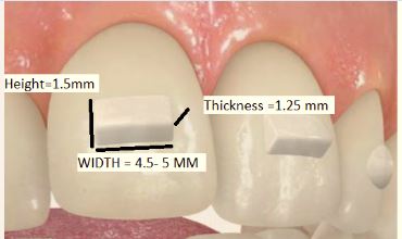 dimensions-of-attachment-2 Why Do I Need  Attachments Bonded to My Teeth for Invisalign?