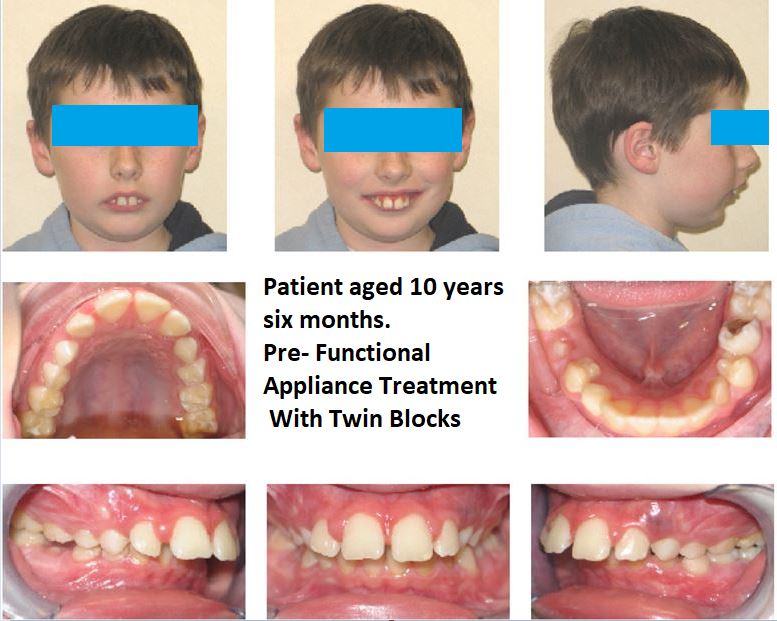 14 Can Orthodontic Functional Appliances Really Make the Lower Jaw Grow?