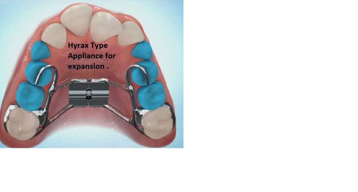 Correction of CrossBites / Use of Expanders Clonmel Orthodontics