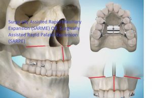 PIC-SARME-300x194 Sideways Expansion in Orthodontics