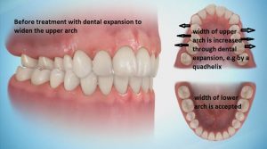 Pic-transverse-un-corrected-300x167 Sideways Expansion in Orthodontics