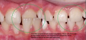 correction-of-anterior-cross-bite-with-elastics.-300x142 What is interceptive orthodontics?