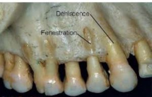 dehiscence-and-fenestration-300x192 Sideways Expansion in Orthodontics