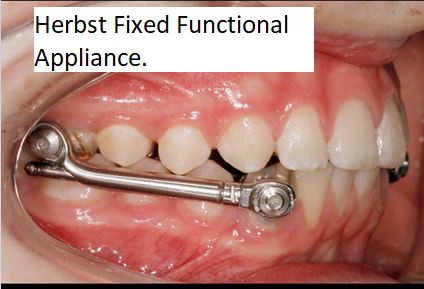 herbst Can Orthodontic Functional Appliances Really Make the Lower Jaw Grow?