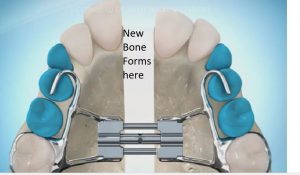 new-bone-300x175 Sideways Expansion in Orthodontics