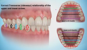 pic-1-300x172 Sideways Expansion in Orthodontics