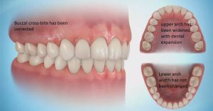 pic-transverse-corrected-300x157 Sideways Expansion in Orthodontics