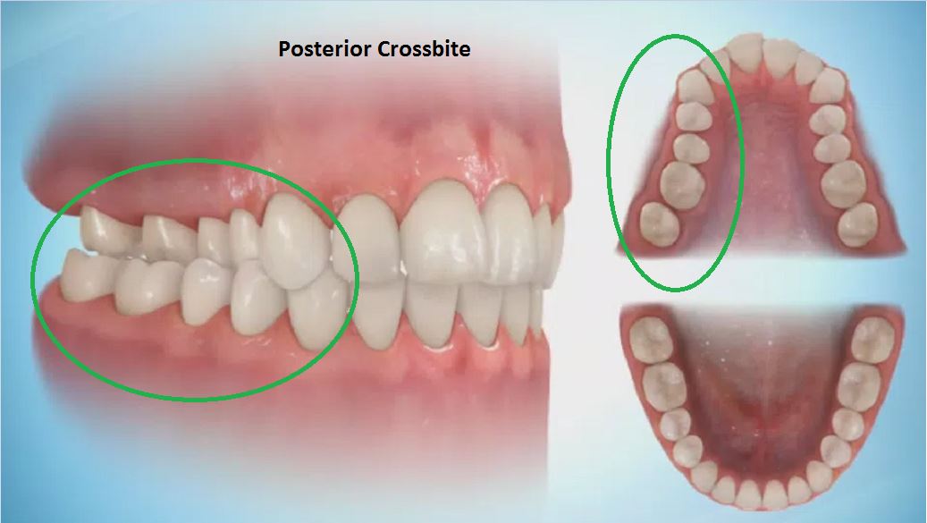 When to Use Cross Elastics- Brody, Scissor, and Posterior Crossbite