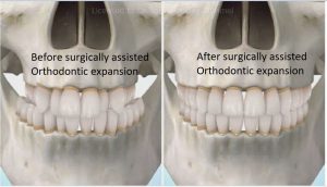 sarme-pre-and-post-300x172 Sideways Expansion in Orthodontics