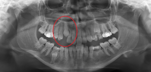 A-ken-post-ext-300x144 What is interceptive orthodontics?