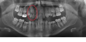 A-ken-pre-ext-300x148 What is interceptive orthodontics?