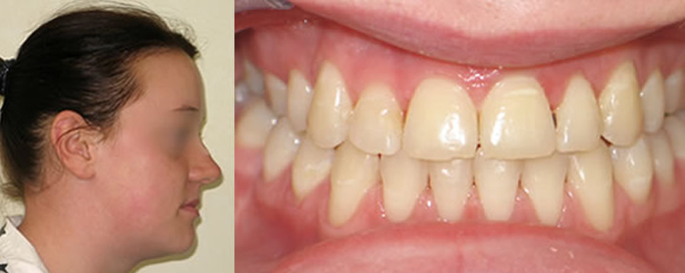 after1 Orthognathic Surgery after1 Orthognathic Surgery