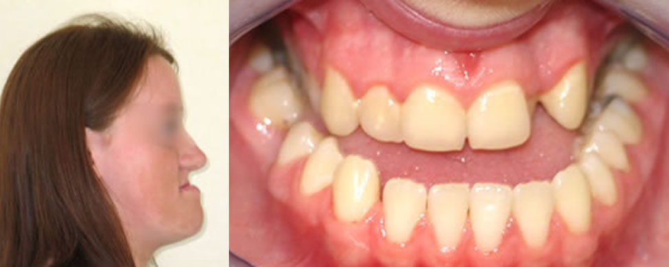 before1 Orthognathic Surgery before1 Orthognathic Surgery