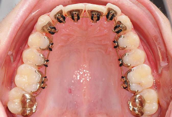 lingual1B1 Lingual Braces