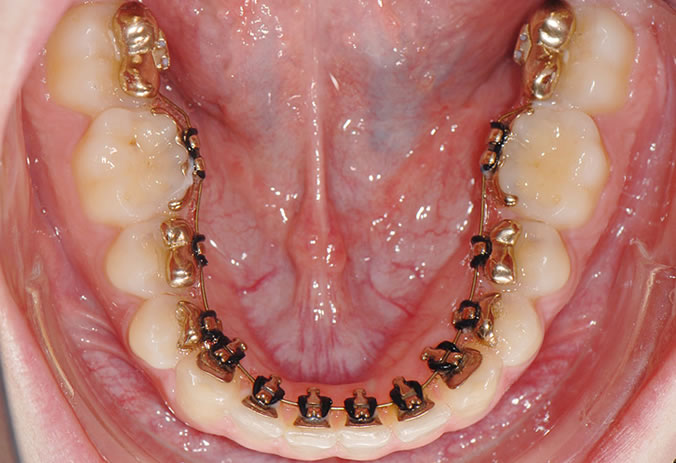 lingual2 Lingual Braces