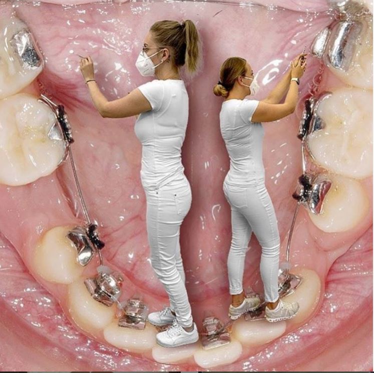 lingual-appliance-inside What is Invisalign and How Does it Make Teeth Move ? Part A.