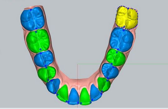 segmented-arch What is Invisalign and How Does it Make Teeth Move ? Part A.