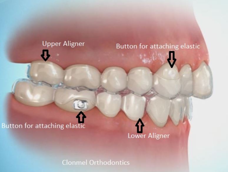 Aligner-with-buttons-2 What is Orthodontic Wax for?