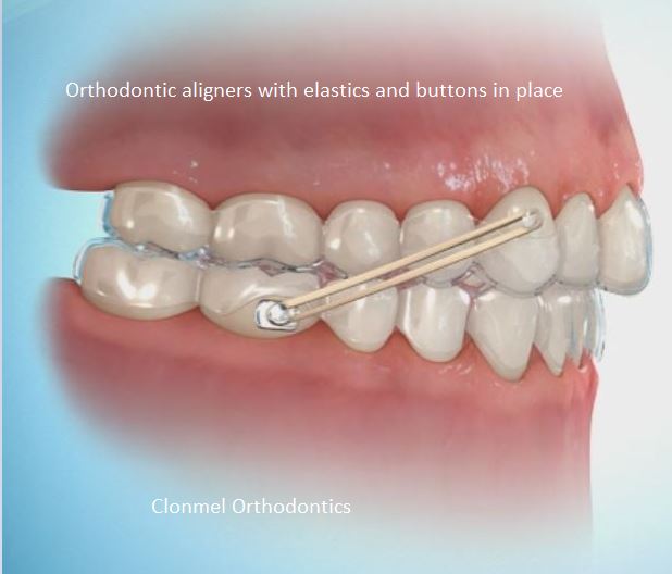Aligners-with-elastics What is Orthodontic Wax for?