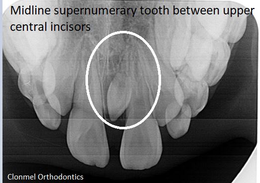 Midline-supernemerary-3 What are supernumerary teeth?