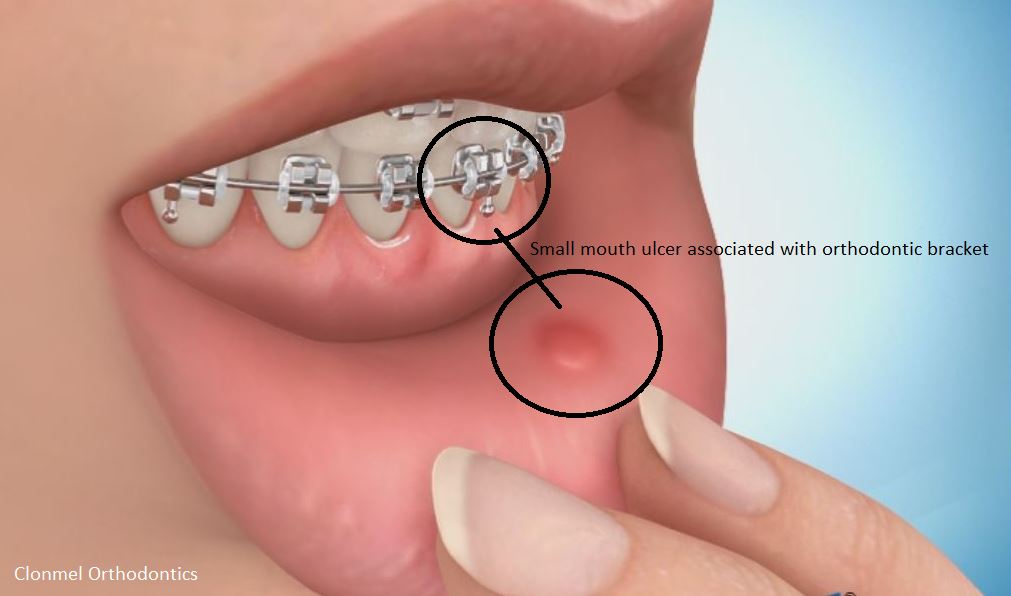 Mouth-ulcer-associated-with-bracket What is Orthodontic Wax for?