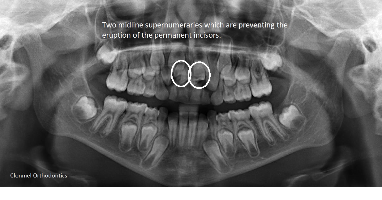 Multiple-Supernumeraries What are supernumerary teeth?