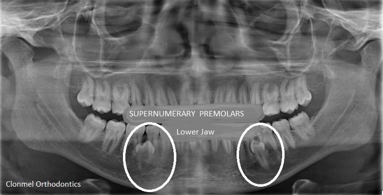 Supernumerary-premolars-3-1 What are supernumerary teeth?