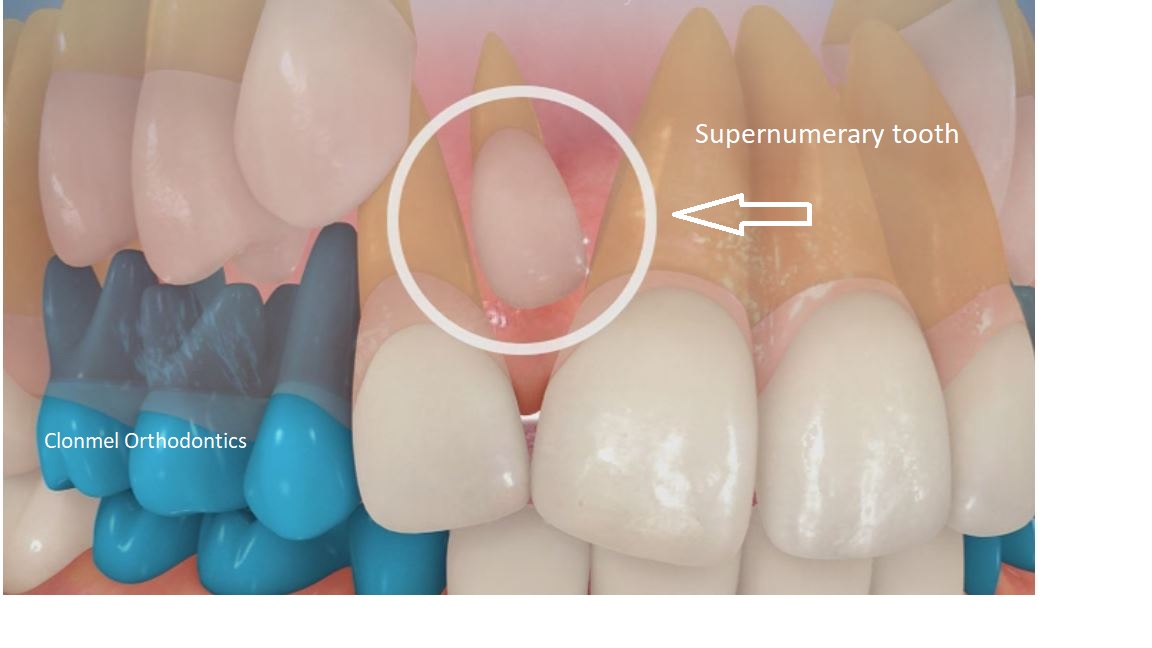 Supernumerary1 What are supernumerary teeth?