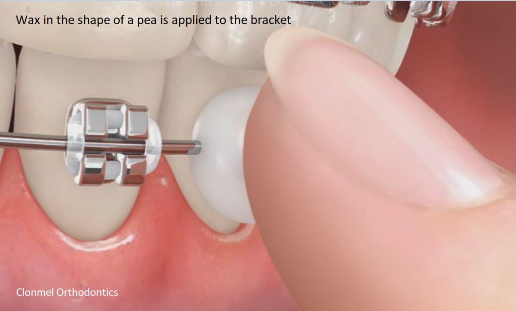 Wax-applied What is Orthodontic Wax for?