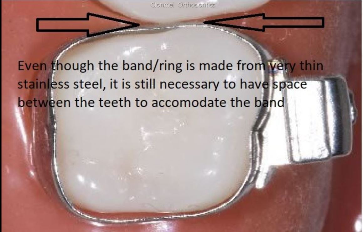 band-2 What are Orthodontic Separators / Spacers?