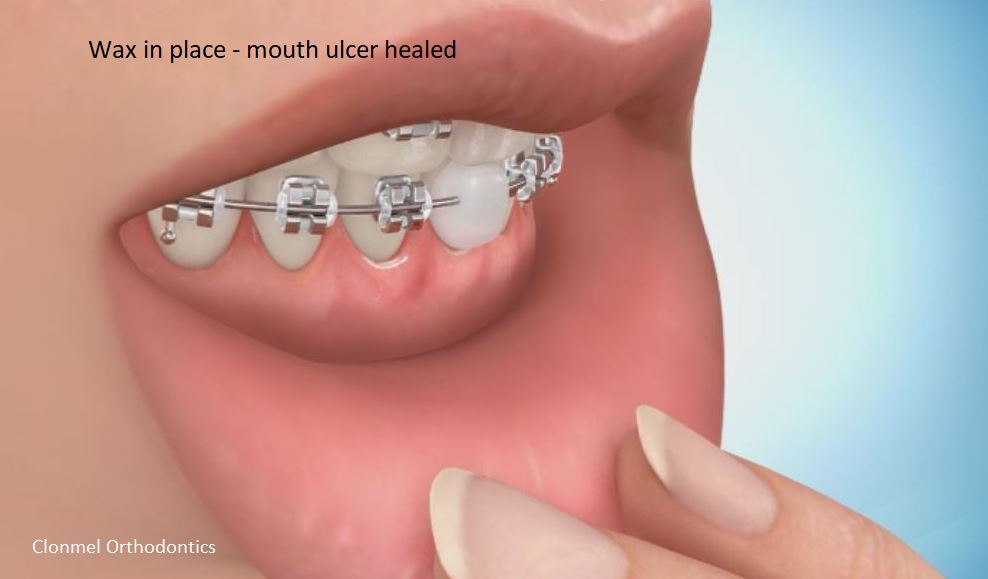 mouth-ulcer-healed What is Orthodontic Wax for?