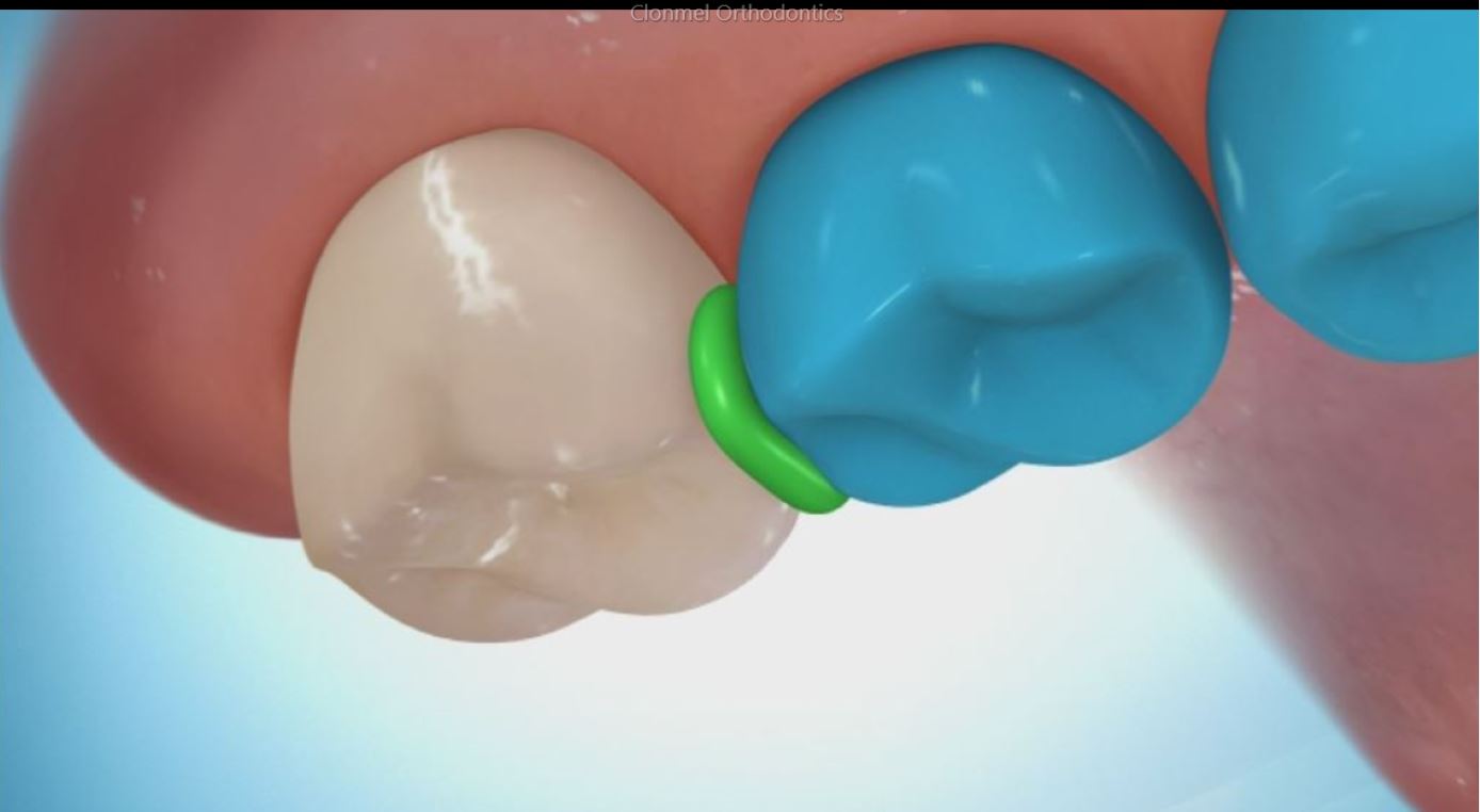 separator-11-watermark What are Orthodontic Separators / Spacers?