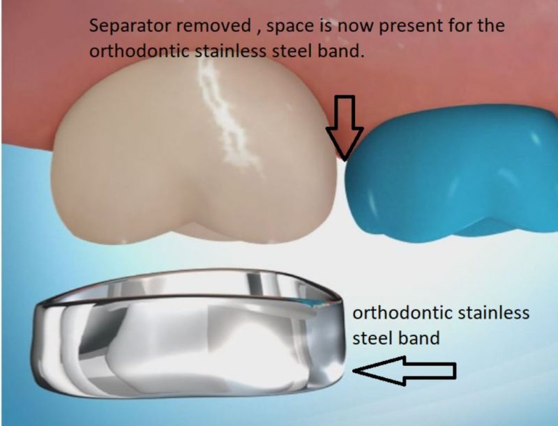 What are Orthodontic Separators / Spacers? Clonmel Orthodontics