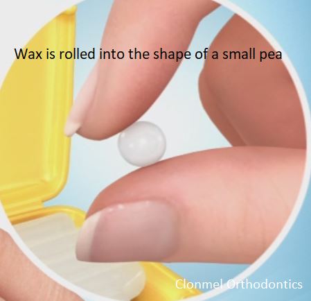 wax-in-the-shape-of-a-pea What is Orthodontic Wax for?