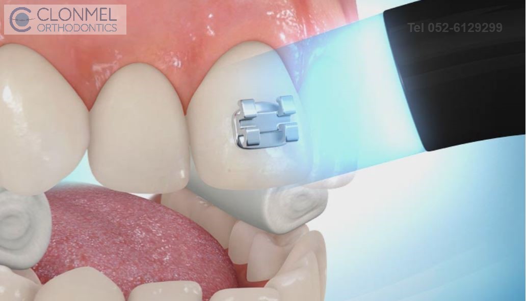 Bracket-placed-2 How are braces  put/placed on the teeth?