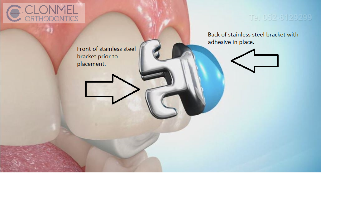 Bracket-with-composite-1 How are braces  put/placed on the teeth?