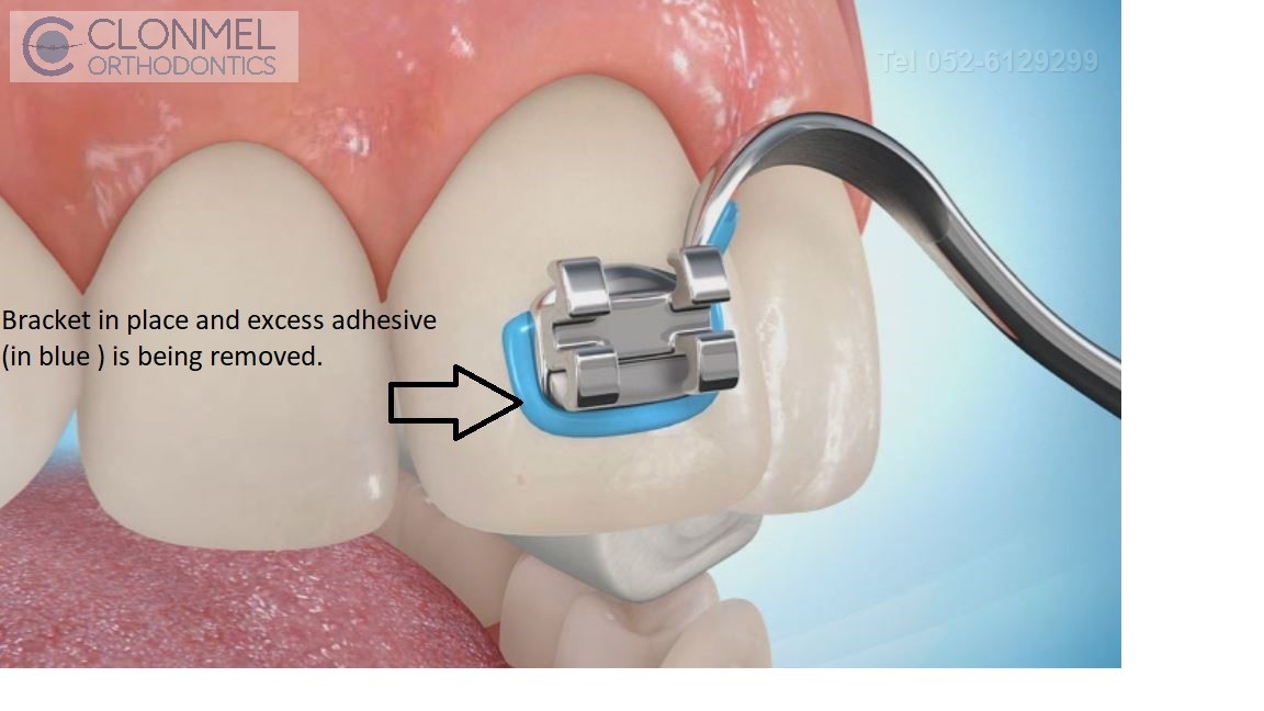 Bracket-with-flash-being-removed How are braces  put/placed on the teeth?