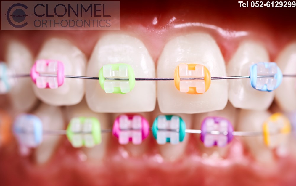 Colours-on-ceramic-braces-pw What are Coloured Braces?