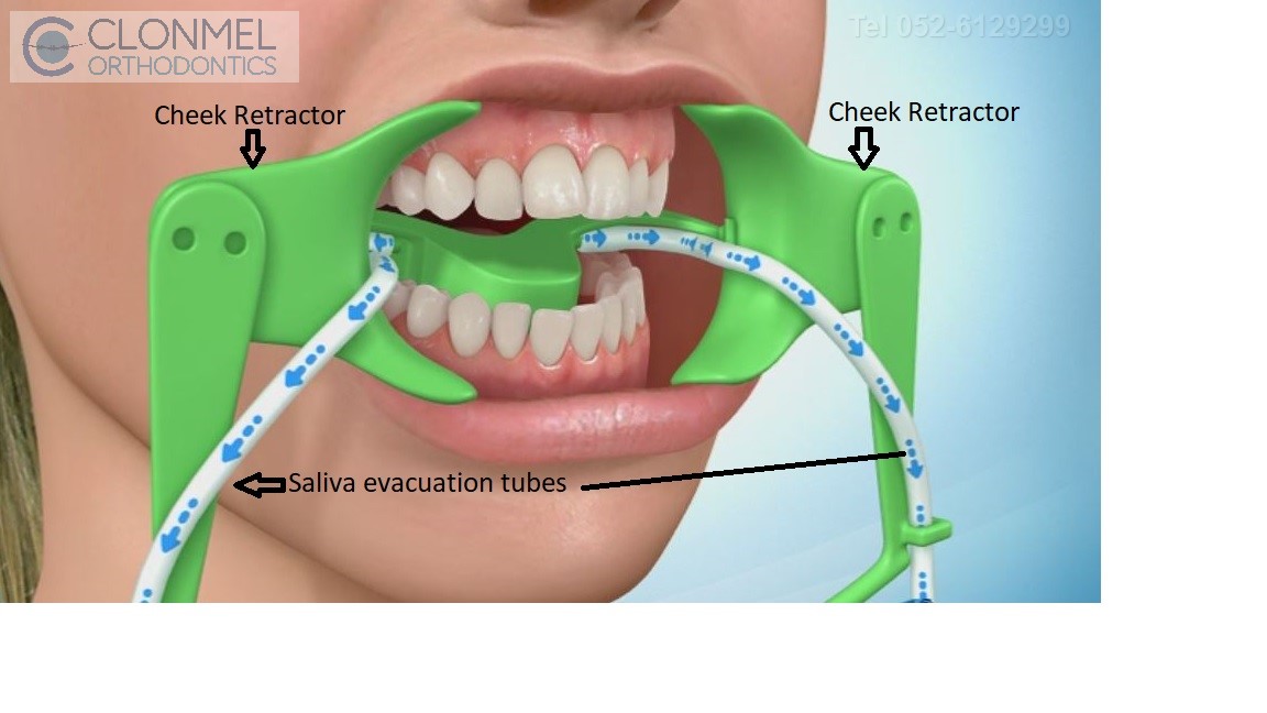 Complete-Nola-Retractor What are bonded  (fixed) orthodontic retainers?