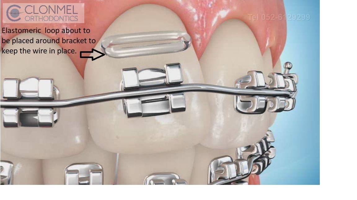 Elastomeric-about-to-be-placed How are braces  put/placed on the teeth?
